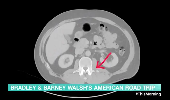 Bradley Walsh's X-ray after breaking his back in three places