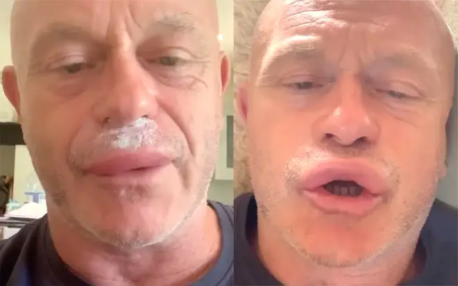 Ross Kemp stung by wasps on his lips leaving actor in hospital
