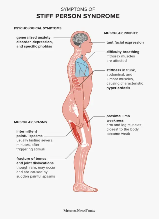 According to John Hopkins Medicine, Stiff Person Syndrome is "a rare autoimmune neurological disorder that most commonly causes muscle stiffness and painful spasms that come and go and can worsen over time.